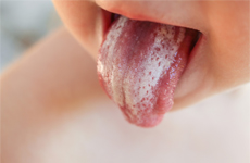 [Translate to French:] Tongue of a toddler with white plaque